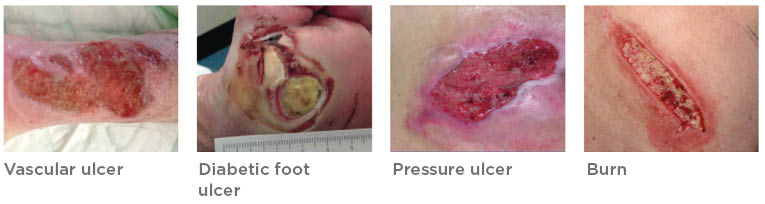 UrgoClean Ag ulcers