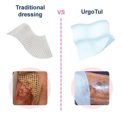 Traditional dressing vs UrgoTul